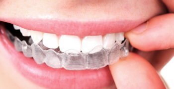 Invisalign Invisalign