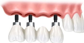 Dental-Treatment-Implant-Supported-Bridge tooth implant