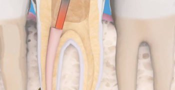 Dental-treatment-Root-Canal-Therapy root canal treatment
