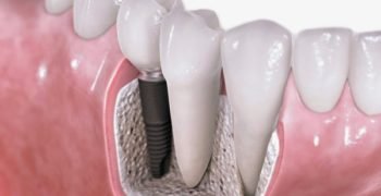 Dental-treatment-Single-Tooth-Implant-Replacement tooth replacement
