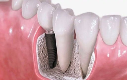 Dental Implants Dentist Hamilton Relax Dental