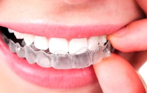 Invisible Braces Dentist Hamilton Relax Dental