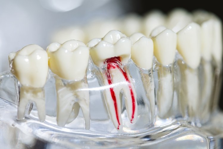 root canal treatment hamilton